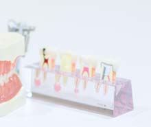札幌市豊平区 たく歯科 虫歯の進行段階とその治療法