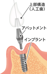 札幌市豊平区 たく歯科 インプラント治療