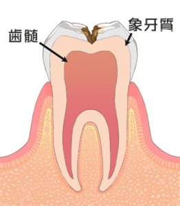 札幌市豊平区 たく歯科 虫歯治療　c2