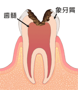 札幌市豊平区 たく歯科 虫歯治療　c3